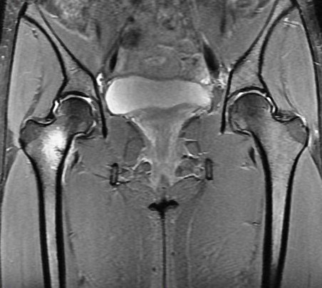 Figure 2 for case Calcar stress fracture ( RID4695 )